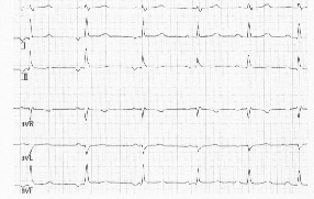 Foto eines EKG-Streifens